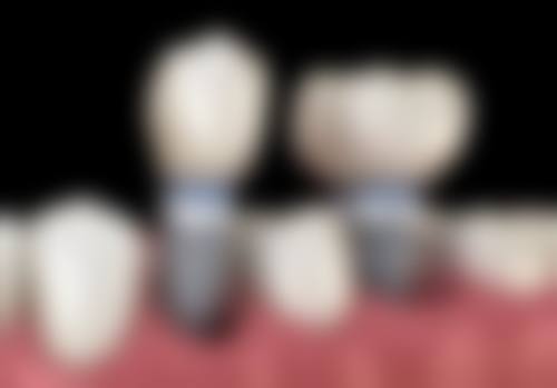 香港 大陸種牙幾多錢 診所揀選要點：3步避開黑診所