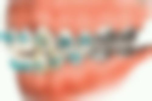 五、成人牙齿矫正费用大概多少？不同方案价格跨度大