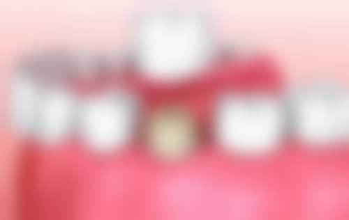 拓展延伸：植牙項目真相+關鍵選擇點+避坑指南