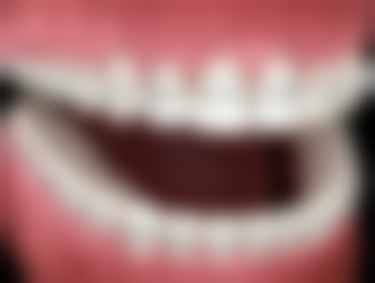 六、4岁儿童龋齿如何日常预防?这些措施要做好