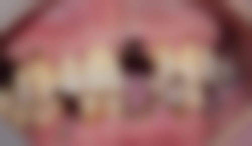 拓展延伸：allon4植牙真相+關鍵選擇點+避坑指南