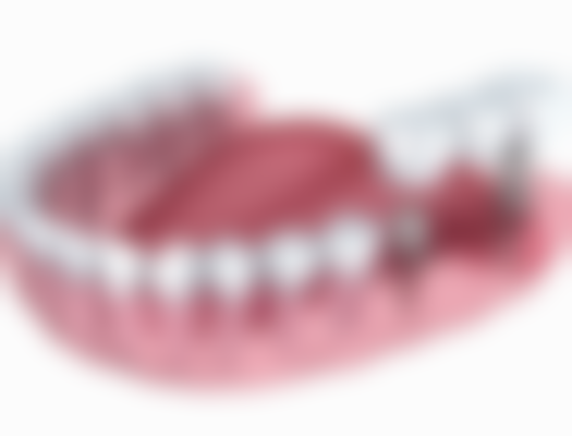 香港 allon4植牙費用香港 適合邊類人群？呢幾類人更啱做！