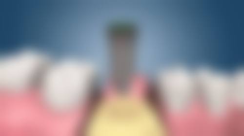 香港箍牙必睇2026：格倫菲爾vs鼎植技術價錢│慳50%免排隊攻略