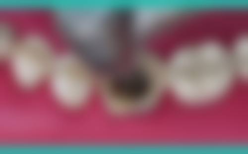 根管治療關鍵選擇點：香港人必睇