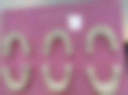 五、弄了烤瓷牙矫正牙齿安心吗 / 有哪些风险