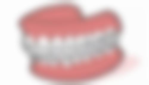 三、种牙第二次手术复杂吗