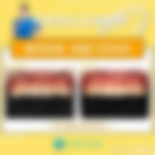 五、种植牙与烤瓷牙的手术过程及修复周期