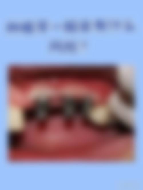 香港vs深圳口岸微創植牙：邊個抵啲？（附價錢對比）