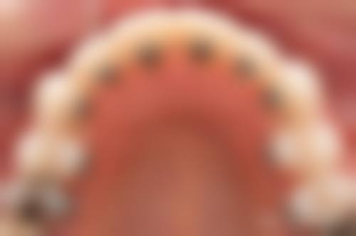 七、儿童牙齿长歪了怎么办？一招教你牙齿整整齐齐