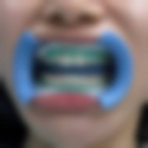 二、哪些情况儿童矫正牙齿需要拔牙？