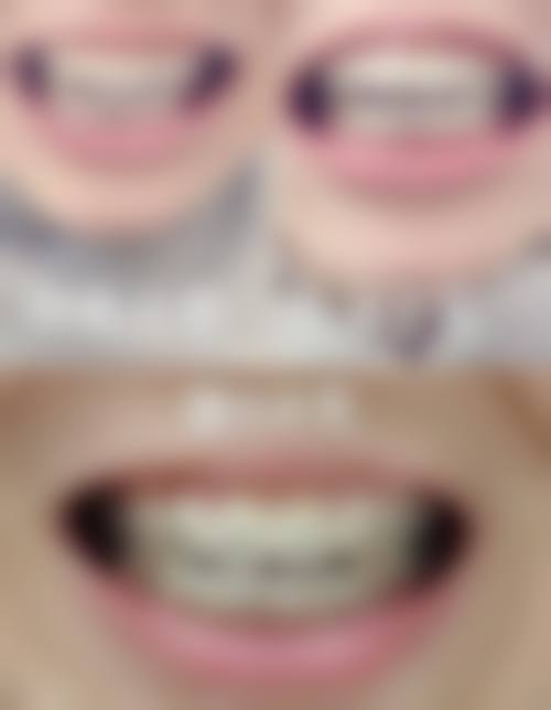 深圳整牙術前術後避坑指南（香港姊妹必讀）