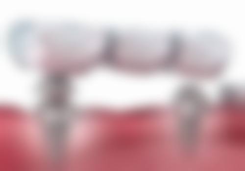 全口植牙費用香港:深圳VS香港邊個好?