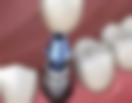 理性提醒:深圳種牙安心第一,唔好貪平去無牌診所!