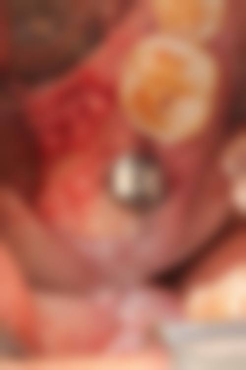 深圳即刻種牙邊間好 關鍵選擇點:按自身情況揀更啱!