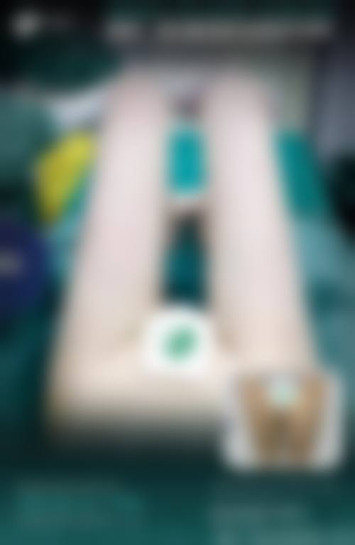 九、大腿吸脂的后遗症