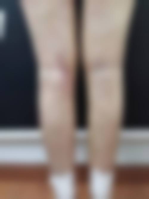 三、影响大腿吸脂消肿时间的因素