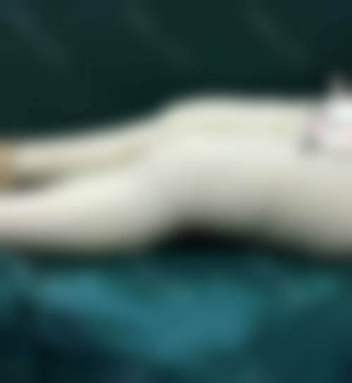 五、大腿吸脂的适合人群