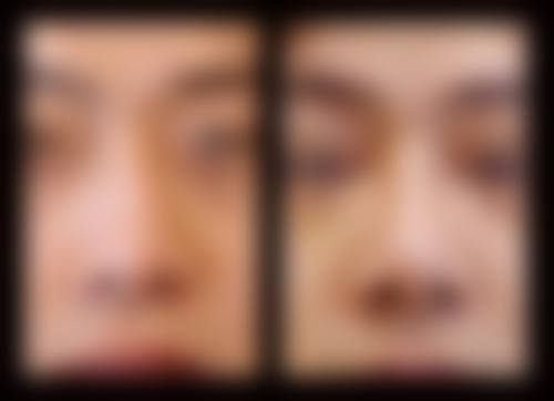 六、医生详解3个月稳定期,如何把握关键修复期?