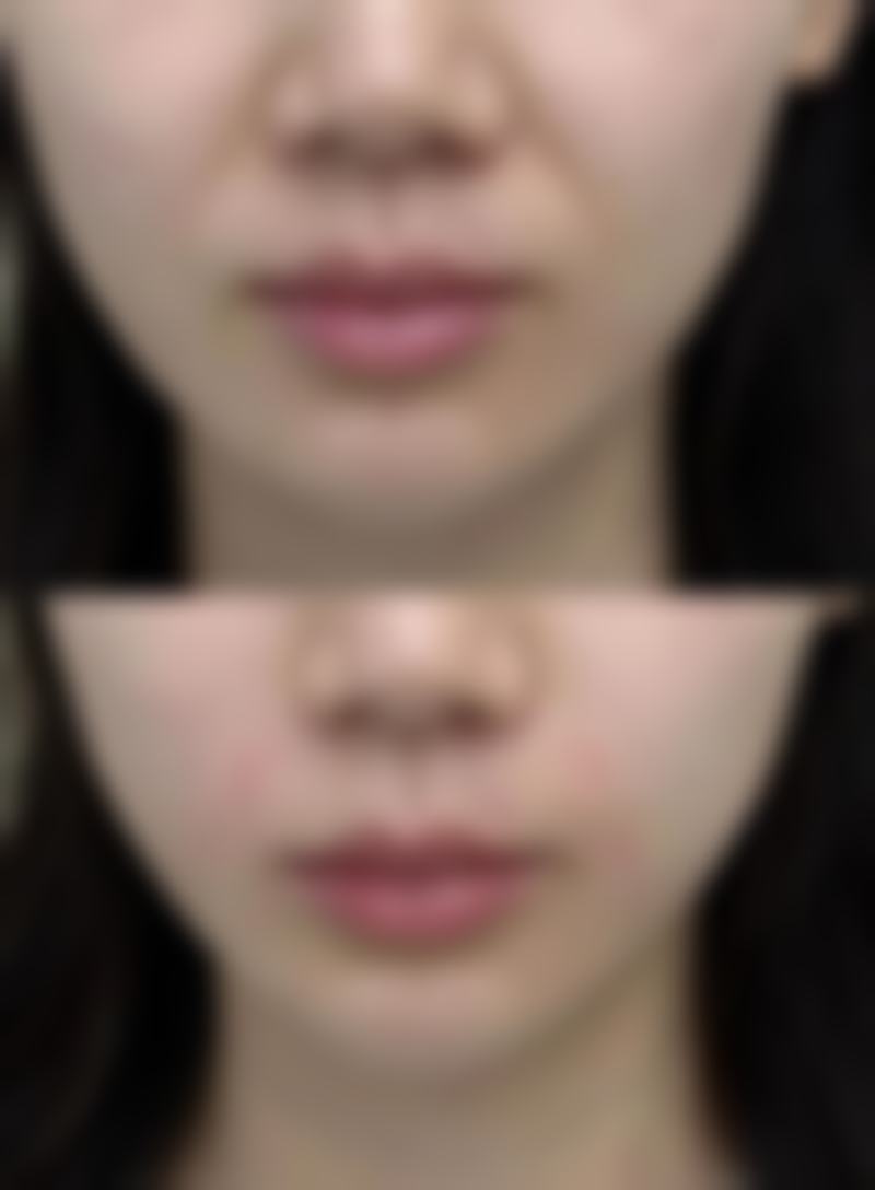 韓國evita胸部外科醫院價格表2026中韓報價 診所揀選要點:港澳姊妹必睇3大細節