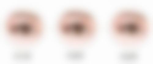 4. 疤痕增生修复手术