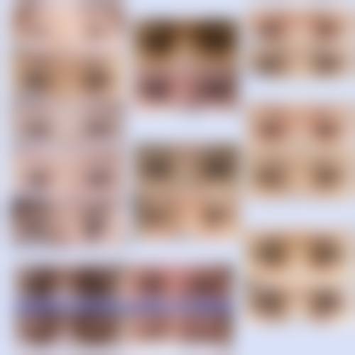 四、去眼袋成效如何