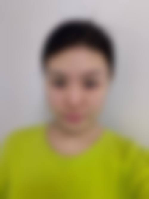 下颌角补骨少了怎么办？别慌，看真实修复案例与PEEK材料如何重塑自然轮廓