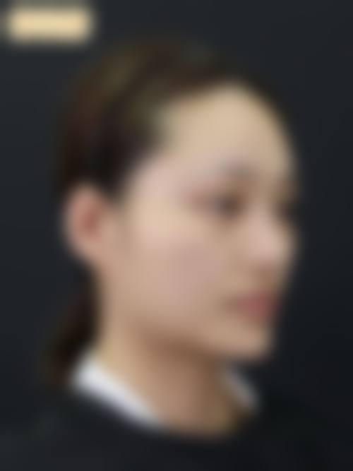 二、下颌角补骨修复成功的么