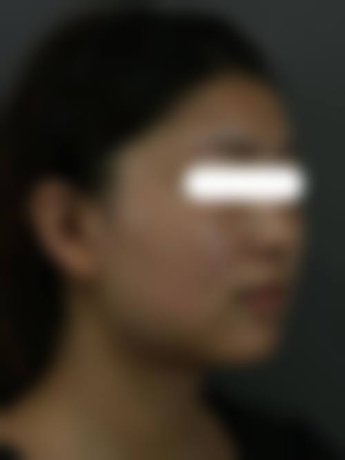 三、下颌角补骨修复真实实例