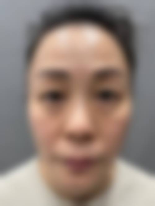 八、去眼袋医院医生如何选择