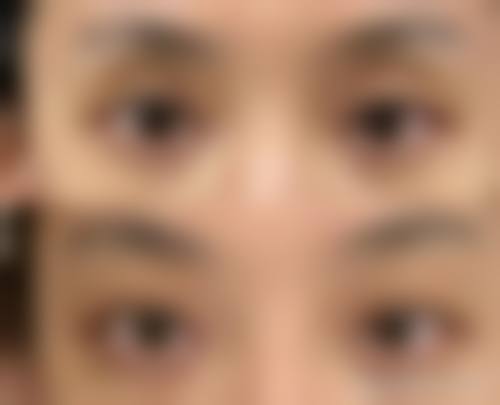 七、怎么判断自己是否适合去眼袋