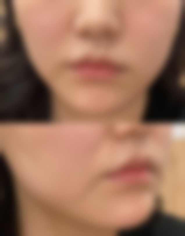2. 糖尿病足治疗
