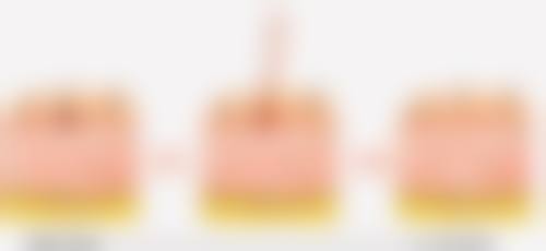 韓國鼻子失敗重修实例 適合邊類人群