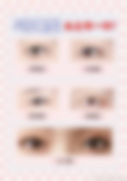 七、6D双眼皮手术风险及注意事项