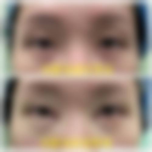 四、6D双眼皮手术