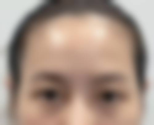 十、陈光平擅长项目科普:2C双平面隆胸介绍