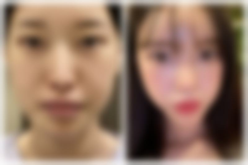 韓國鼻子失敗重修实例 真實实例分享