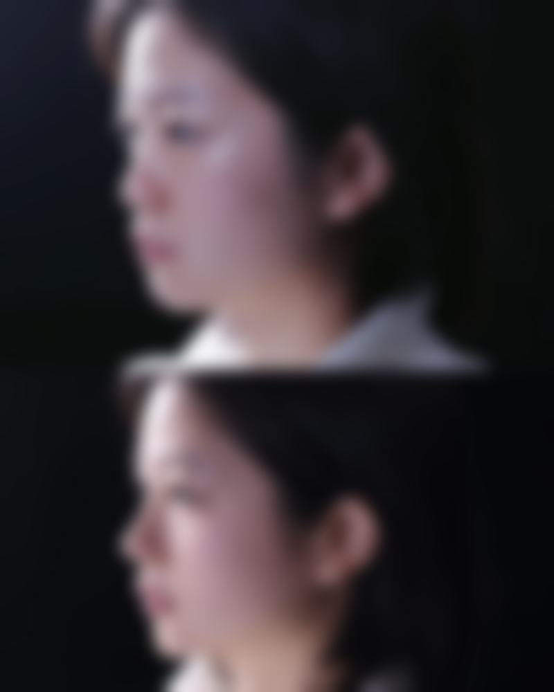 韓國鼻子失敗重修实例 術前術後避坑指南