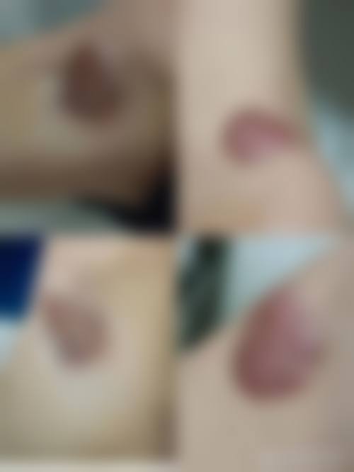 五、缝合后疤痕修复成效如何
