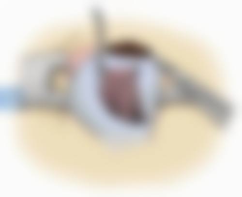 （2）微创玻璃体切割术——精细治疗眼底重症