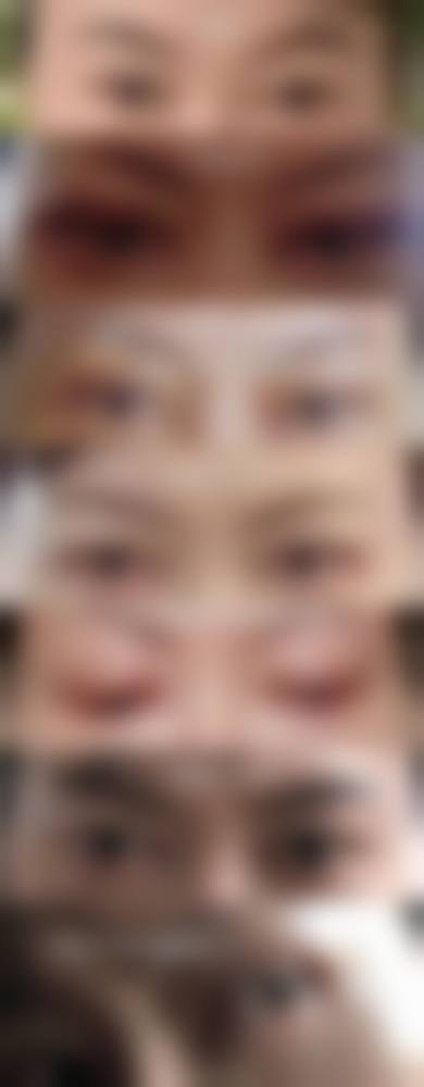 三、动态重睑术的优势有哪些