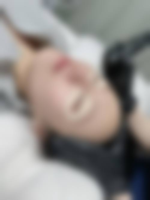 四、睑缘调整术如何解决大小眼问题