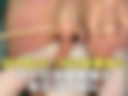 六、价格大比拼:手术隆鼻和注射隆鼻哪个性价比高?