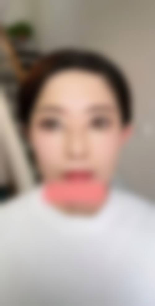 五、眼袋手术后如何保养不再复发