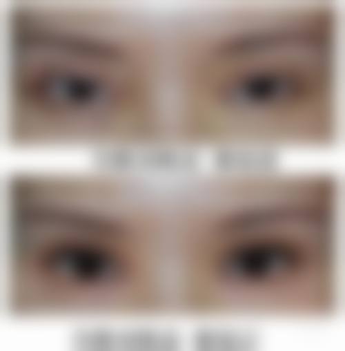 六、眼袋手术后的复发风险