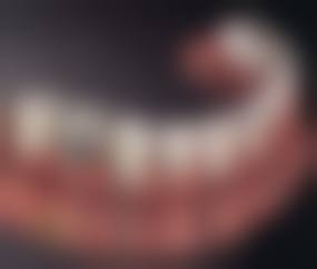 诊疗特色总结 黄洪赠 广州奥洋口腔