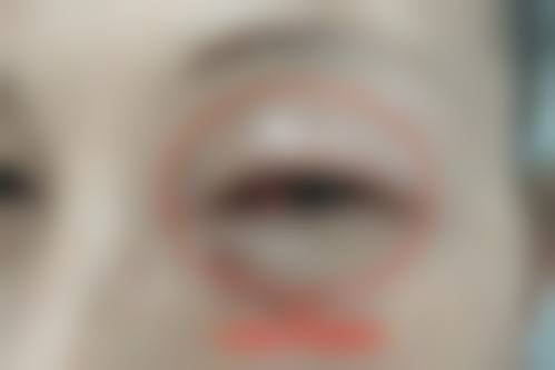 普瑞眼科集团治疗反馈与口碑评价。