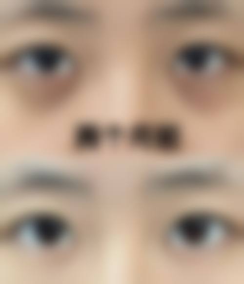 三、眼袋手术后的护理方法