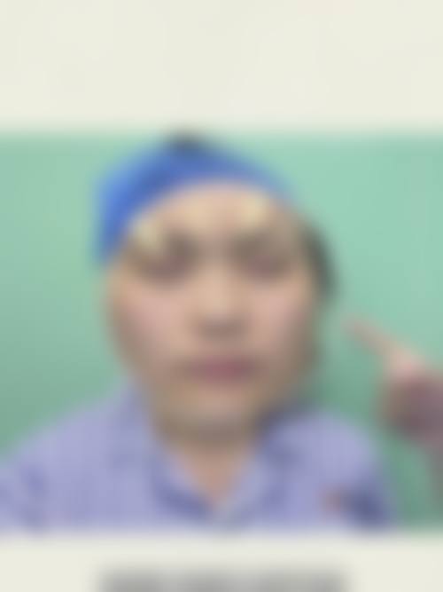 内吸去眼袋为什么会有皱纹?