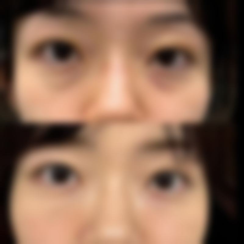韓國整形醫院會唔會中途加價 适合边类人群(港澳实例睇真啲)