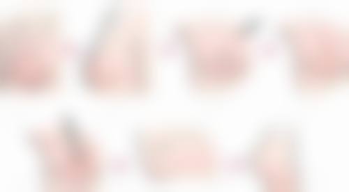 (1)3D精细面部吸脂技术